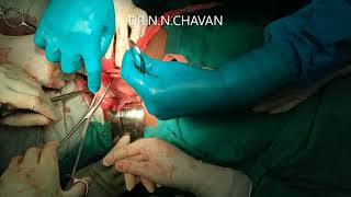 Abdominal Shirodkar's Sling Surgery for Prolapse in a Young Patient by Dr. Niranjan Chavan(57)