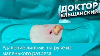 Удаление липомы на руке из маленького разреза