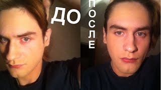 Как исправить лопоухость без операции. Отзыв про корректоры Отостик  Otostick