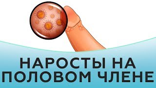 Наросты на половом члене