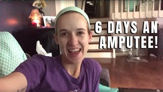 Leg Amputation: Day 6 After Surgery