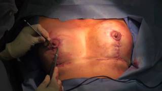 Mastopexy Part 2