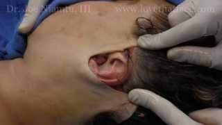 The Truth About Faceift Surgery Part 3