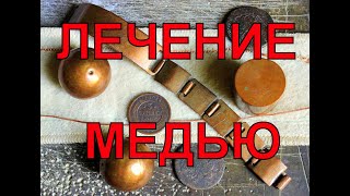 Медь - лечение суставов, мигрени и других болезней.