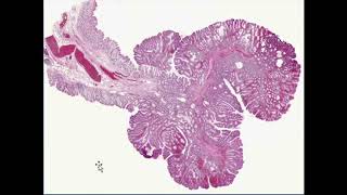 neoplasia robbins pathology full review/ with combined and enhanced quality