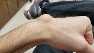Draining and Removing a Huge Ganglion Cyst with Aspiration