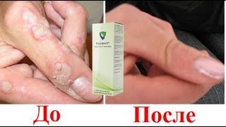 Papiderm - средство от папиллом! Ну очень эффективное средство...