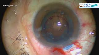 Zepto Hypermature cata with Weak Zonule