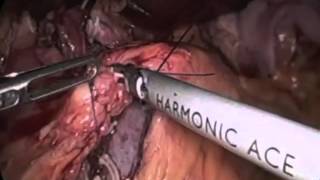 Laparoscopic Pancreaticoduodenectomy (Whipple Procedure)