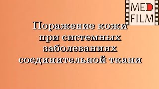 Поражение кожи при заболеваниях соединительной ткани © diseases of connective tissue