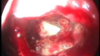 L) Maxillary Fungal Sinusitis   Mini FESS LA