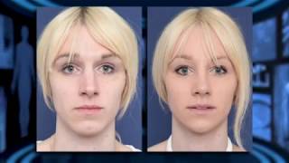 Facial Feminization Surgery - Interview Dr Bart van de Ven