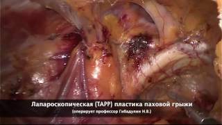 Лапароскопическая пластика (TAPP) при паховой грыже