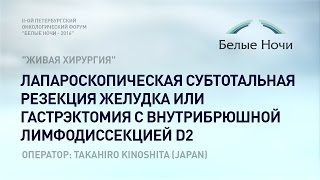 Мастер класс: Лапароскопическая субтотальная резекция желудка или гастрэктомия с лимфодиссекцией D2