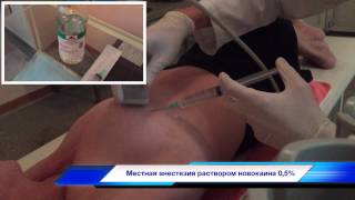 Пистолетная биопсия опухолей молочных желез
