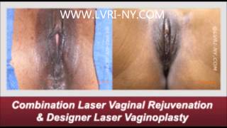 Laser Vaginal Rejuvenation Before and After Photos