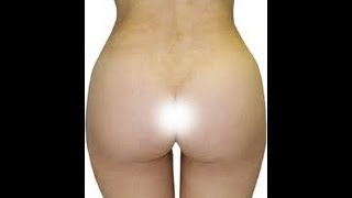 Anal Bleaching Miami Beach (What You Should Know!!!)