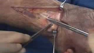 Radius Distal Dorsal Approach