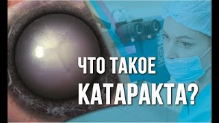 Что такое КАТАРАКТА? Симптомы катаракты. Лечение катаракты в Москве.