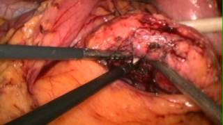 Laparoscopic Splenic and Vessel Preserving Distal Pancreatectomy