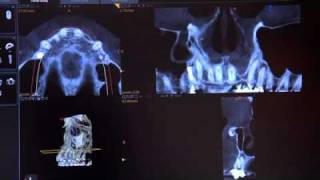 Patient with an Apical Abscess - CS 9300 from Carestream Dental