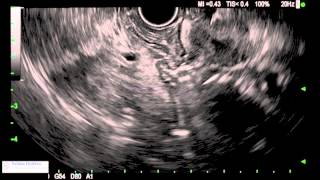 Importance of Uncinate Pull Through - Bronte Holt