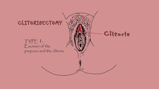 #endcuttinggirls EP21 FEMALE GENITAL MUTILATION IN NIGERIA