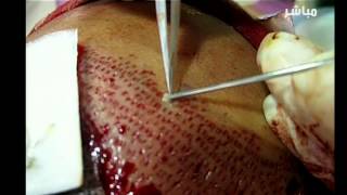 برنامج صحتي : زراعة الشعر 5