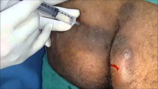 Pilonidal Cyst Abscess Drainage