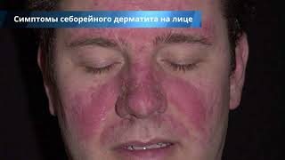 Себорейный дерматит на лице - лечение, причины, симптомы и профилактика
