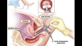 Пап тест: скрининговая диагностика дисплазии шейки матки и предрака