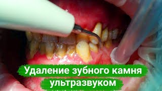 Удаление зубного камня ультразвуком (скалер)