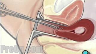 Myomectomy Vaginal Fibroid Removal Surgery PreOp® Patient Education  HD