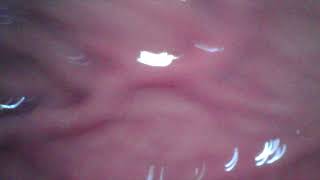 Swallowing a Whole Packet of Small Gummy Bears