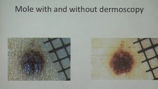 Melanoma and Nonmelanoma Skin Cancer