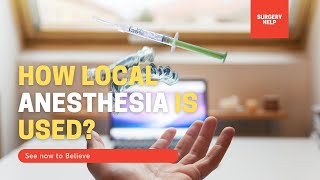 Local Anesthesia for Circumcision Call +919370275336/+919370240098