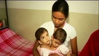 Betul's conjoined twins successfully separated after 12-hour surgery