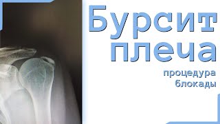 блокада плечевого сустава при калькулезном бурсите