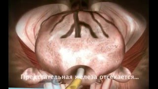 Лапароскопическое удаление простаты