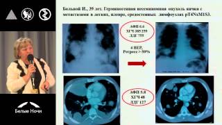 Лечение больных распространенными герминогенными опухолями яичка