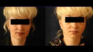 Чем Отличаются Круговая Подтяжка Лица Сегодня и 10 лет назад? Говорит ЭКСПЕРТ /Says Expert/