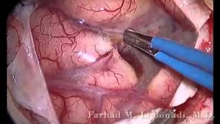 Human brain surgery!! Brain surgery removal of metastatic tumor