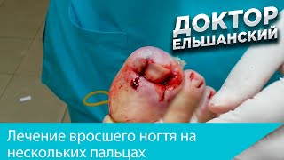 Лечение вросшего ногтя на нескольких пальцах