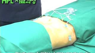 hpl지방용해술 뱃살빼기