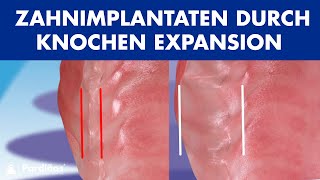 Einsetzen von Zahnimplantaten durch Knochen expansion ©