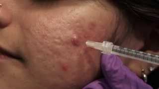 Watch & Learn: Intralesional injections