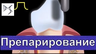 Препарирование зуба под металлокерамическую коронку  Металлокерамика  Ортопедическая стоматология