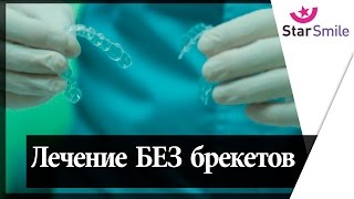 Брекеты? Нет, Элайнеры / капы ★ Star Smile ★ Clear aligner