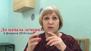 625.Тройничный нерв. Лечение методом RANC в КРАСНОДАРЕ.