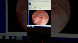 Interventional Pulmonology- Rigid bronchoscopy intubation for central airway obstruction